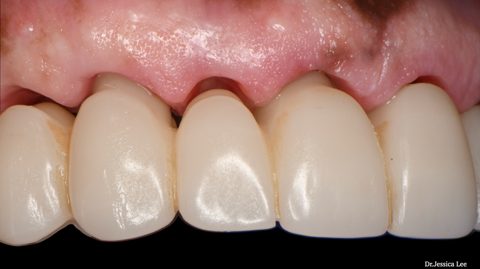 Close-up of dental crowns on a patient's teeth with 'Dr. Jessica Lee' branding.
