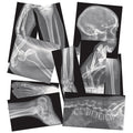Broken Bones X-Rays