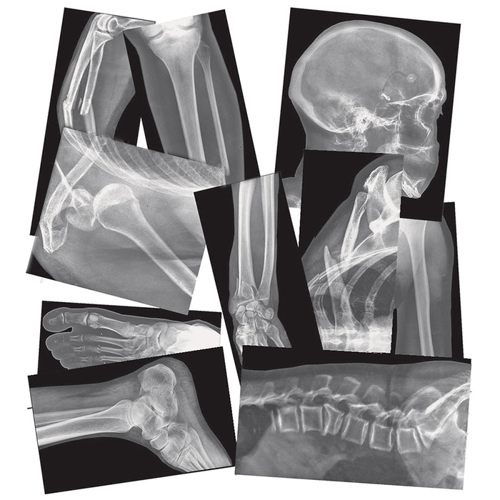 Broken Bones X-Rays